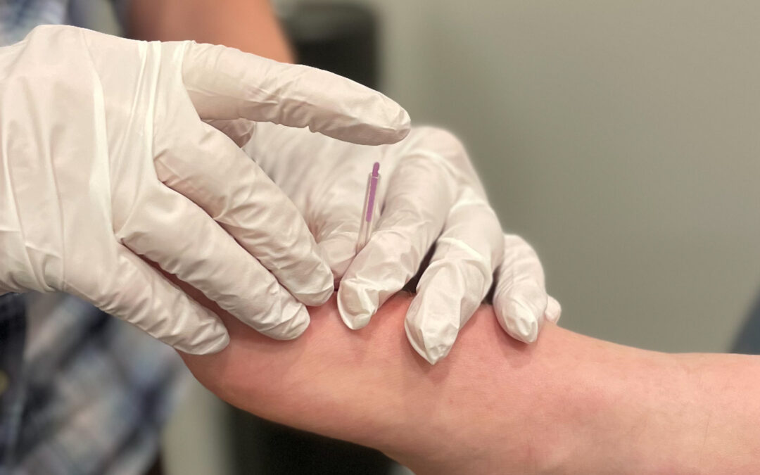 Gloved hands of a physiotherapist holding a bare foot performing dry needling technique