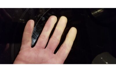 What is Raynaud’s?