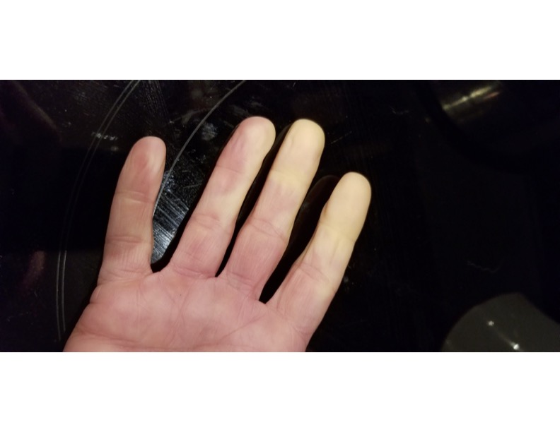 What is Raynaud’s?