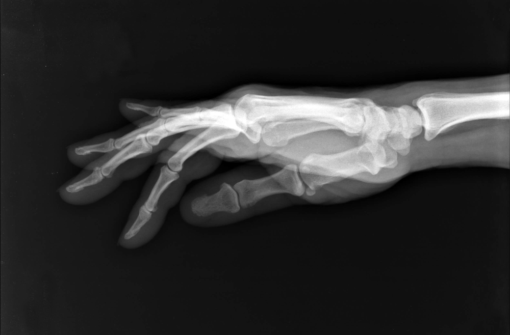 thumb x-ray