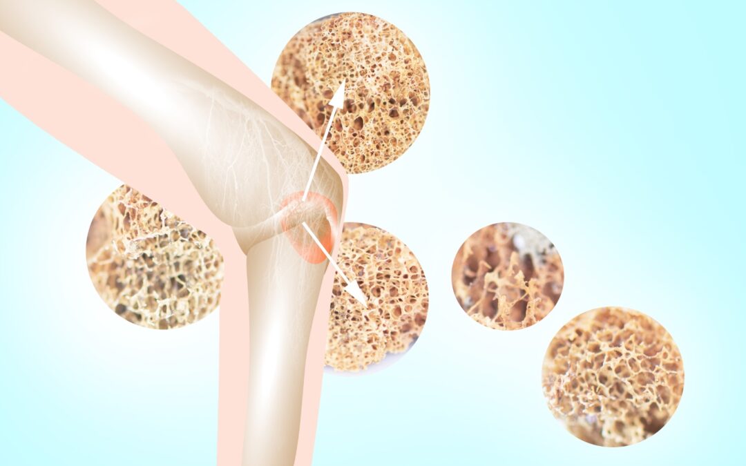 Animated picture of a knee with osteoporosis