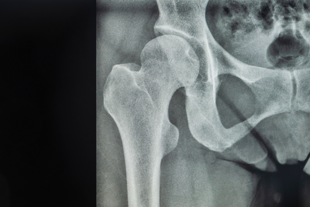 Hip Pain – Strategies to Address Your Osteoarthritis