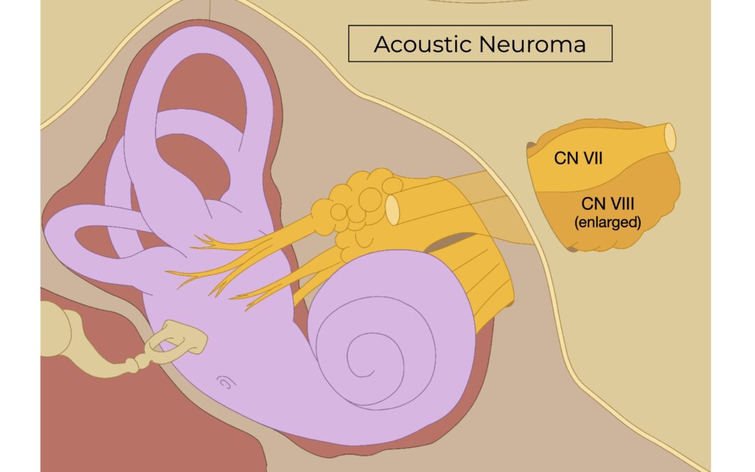 Acoustic Neuroma Review